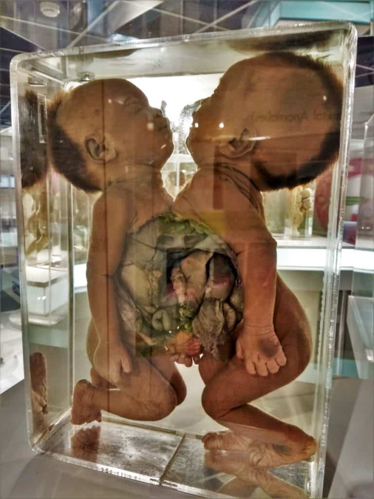 A Case of Eillis Pathological Museum