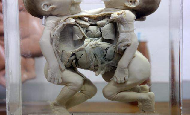 Detail of babies at the Pathology Museum